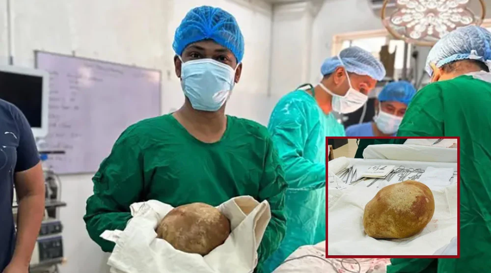श्रीलंकामा बिरामीको मूत्रथैलीबाट ३.१ किलोको पथरी निकालियो